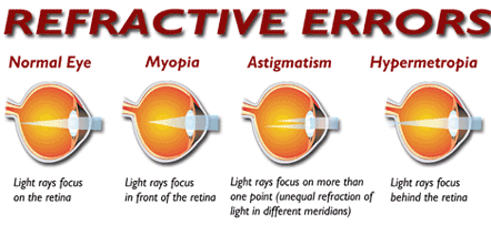 refractive error (myopia hyperopia astigmatism))
