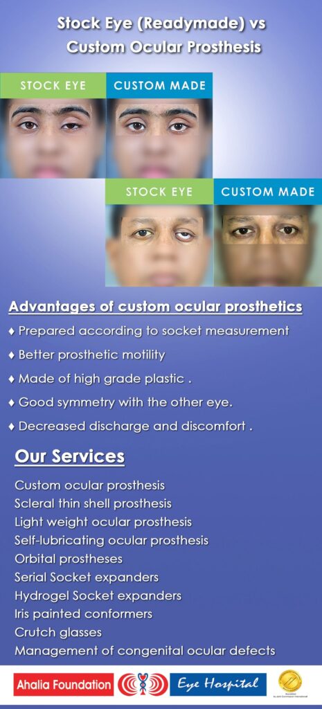 Prosthetic Eye