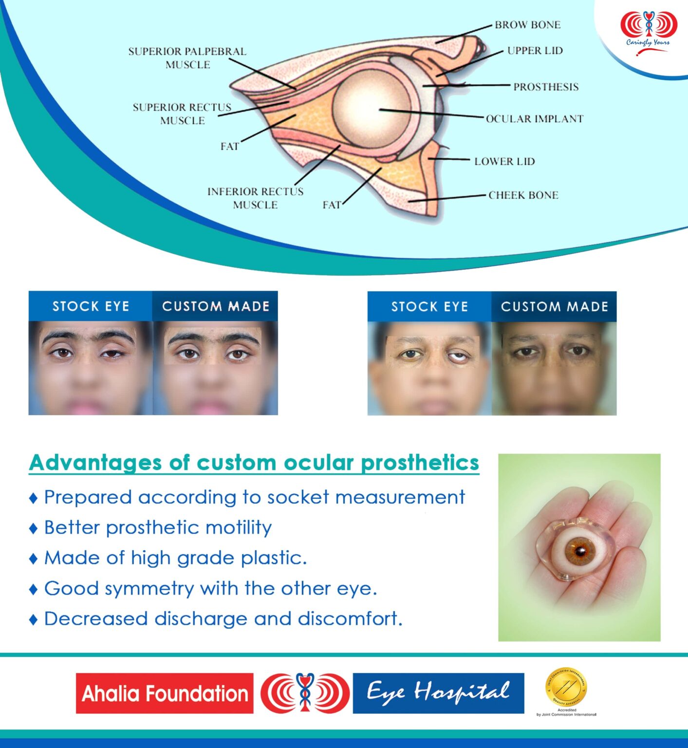 Prosthetic Eye - Ahalia Foundation Eye Hospital